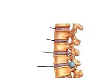 Patru etape de dezvoltare a osteochondrozei